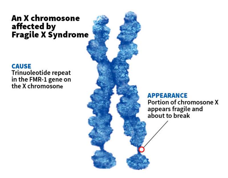 The syndrome was named for the appearance of the affected X chromosome. (Illustration: Scientific American).